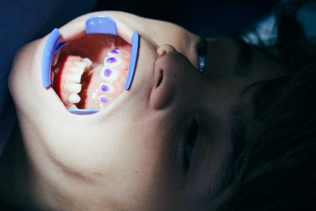 L’apparecchio per i denti